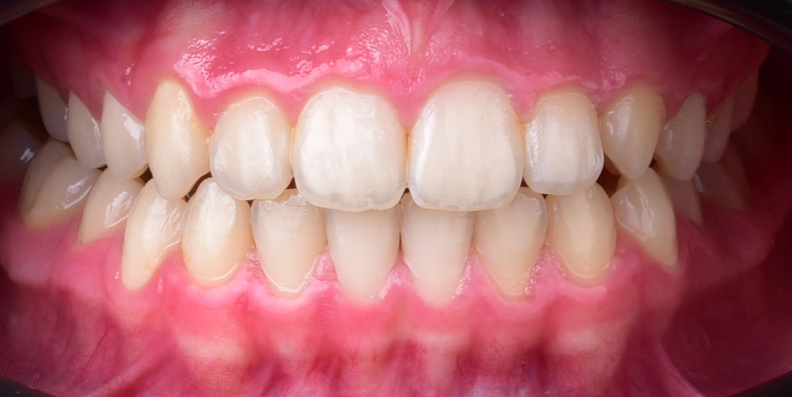 Proste zęby po leczeniu Invisalign